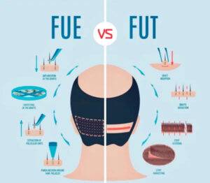 Illustration comparing FUE (follicular unit extraction) and FUT (follicular unit transplantation) hair replacement techniques, showing tools, processes, and treated scalp areas for both methods.