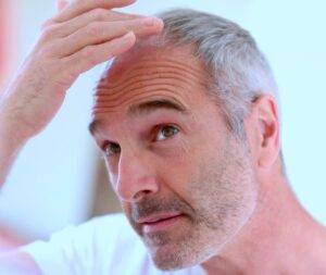 A close-up of a middle-aged man with signs of hair regrowth, touching his forehead thoughtfully, gazing intently towards the camera, with a soft-focus background.