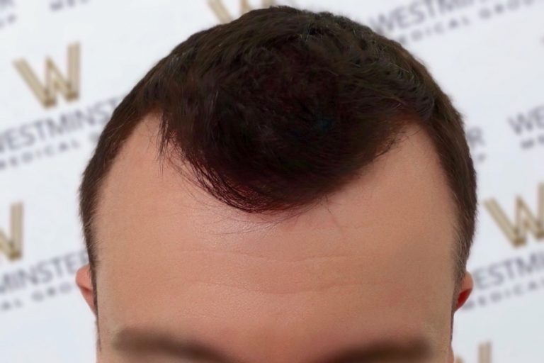 fue hair transplant london