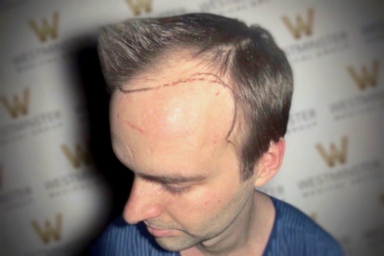 hair transplant london