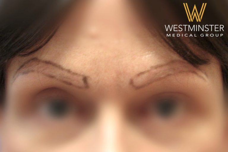 Close-up of a person’s forehead showing eyebrows with black marker lines for a hair replacement procedure. The image is partially blurred, with the "Westminster Medical Group" logo in the top right corner.