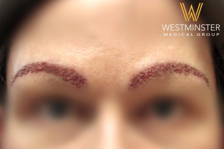 Close-up of a person's eyebrows with fresh microblading, showing detailed, fine hair-like tattoo marks. The image is slightly blurry around the edges with "Westminster Medical Group" logo at the