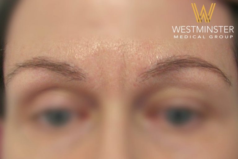 Close-up of a person's forehead and eyebrows with the logo of Westminster Medical Group at the bottom center, following hair implant surgery. The image is slightly blurred towards the edges.