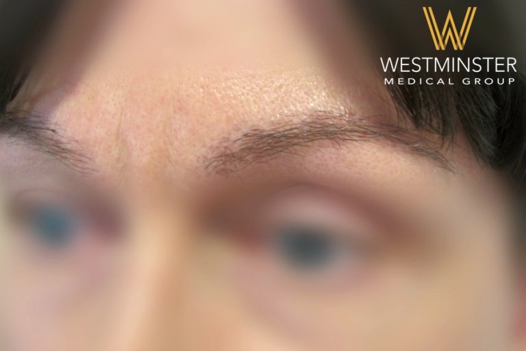 Close-up of a person's eyes looking directly at the camera, with a blurred Westminster Medical Group logo in the top right corner, emphasizing their expertise in female hair loss.