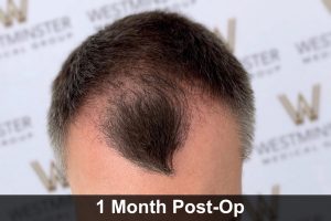 6-12 Month Hair Transplant Regrowth