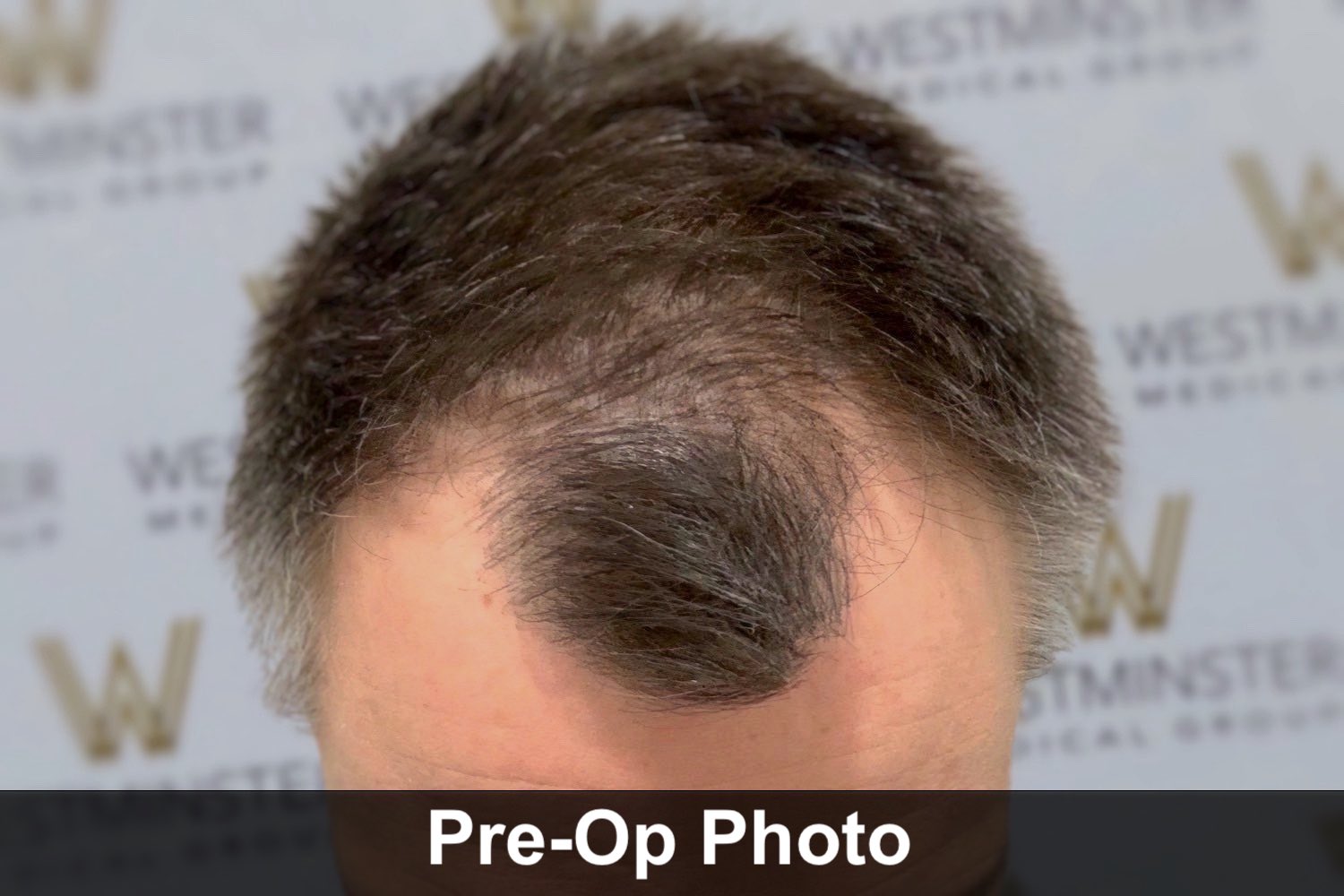 6-12 Month Hair Transplant Regrowth 6-12 Month Hair Transplant Regrowth