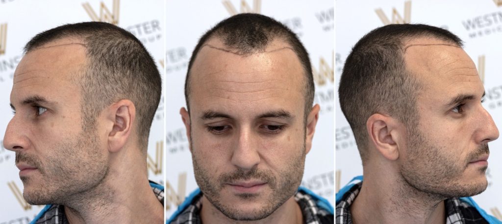 Triple profile views of a man with short hair and male pattern baldness, showing left, front, and right angles against a logo backdrop.