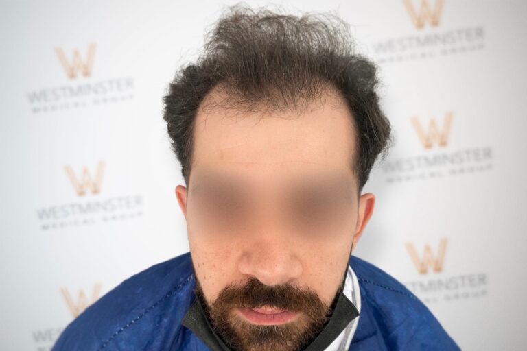 Close-up side profile of a person with curly hair against a backdrop featuring the Westminster Medical logo. The focus is on the person's hair regrowth and the clean, blurred background.