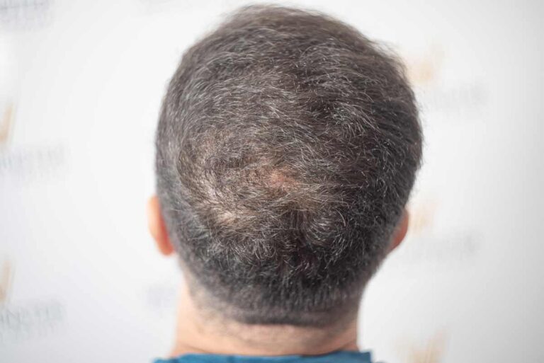 Scalp Pigmentation 9