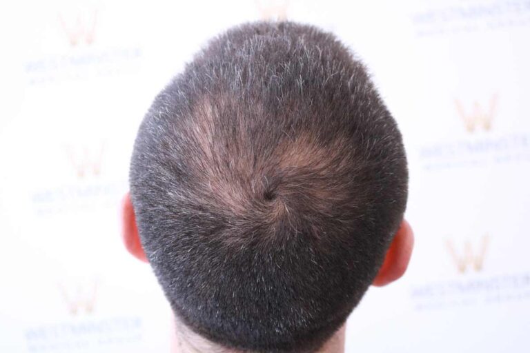 Scalp Pigmentation 3