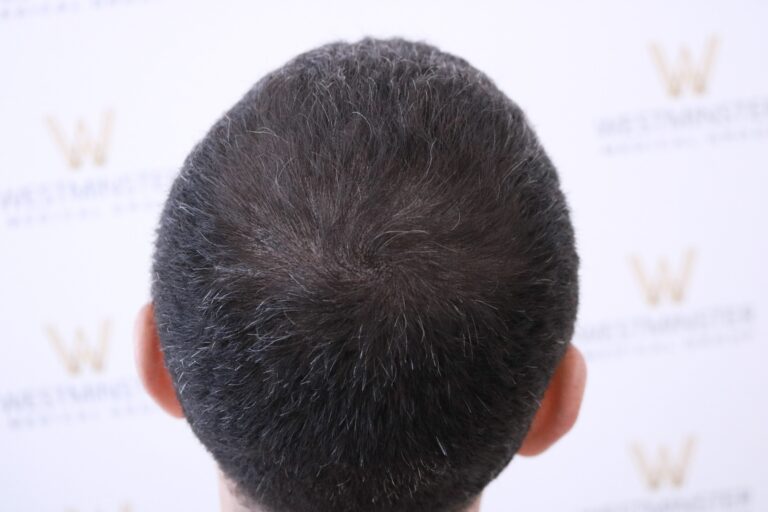 Scalp Pigmentation 4