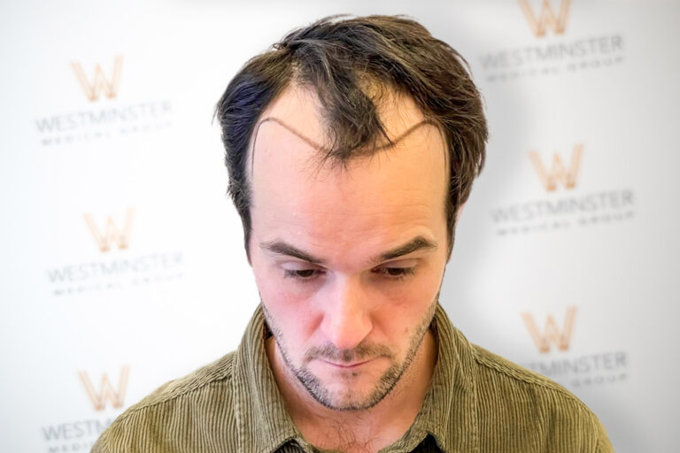 Hair Transplant Results 1