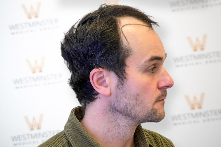 Hair Transplant Results 3