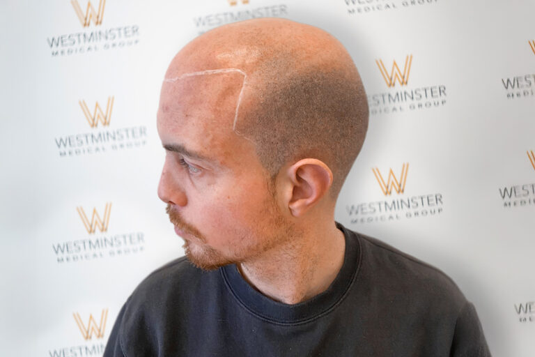 Scalp Pigmentation 1