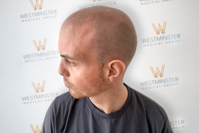 Scalp Pigmentation 2